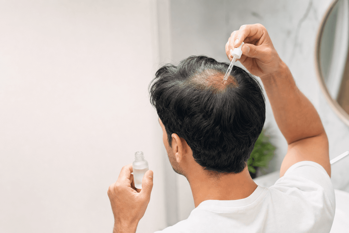 Topisch DMG-Na 0,5 procent ondersteunt haargroei bij pattern hair loss